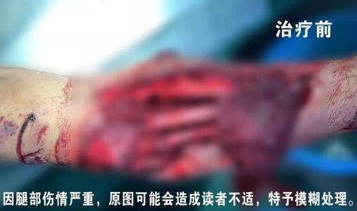 感謝安利醫(yī)院挽救了我的腿，沒有讓我落下殘疾……”