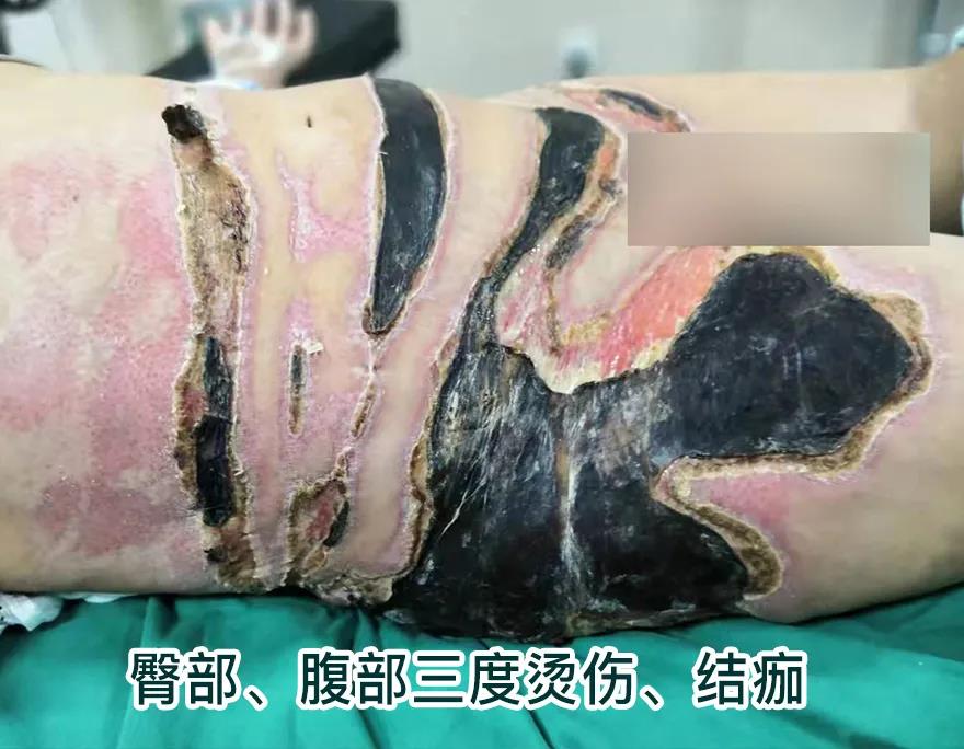 【保山安利醫(yī)院】80歲老人不慎燒傷，導(dǎo)致腹部、右側(cè)臀部大面積創(chuàng)傷，經(jīng)植皮治療創(chuàng)面逐漸愈合